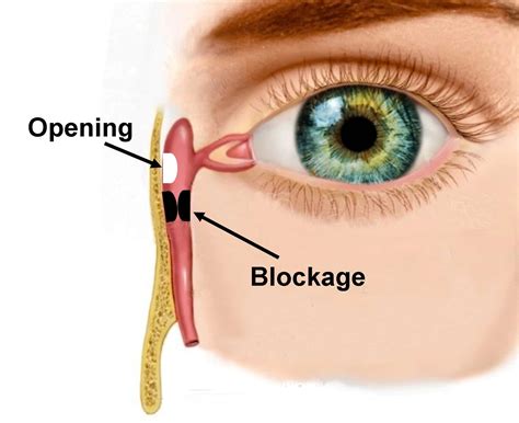 surgery for blocked tear ducts